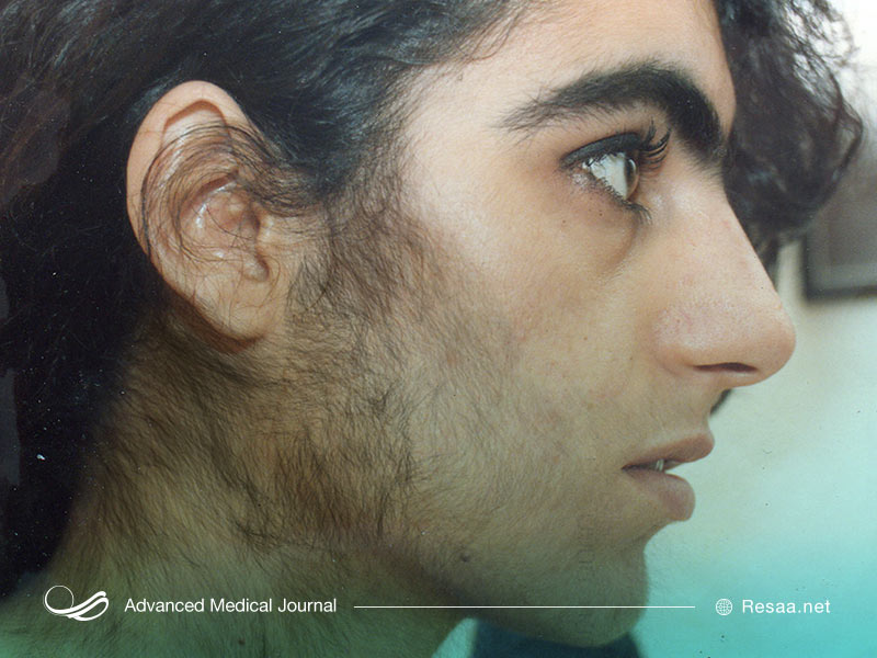 نشانه های پرمویی