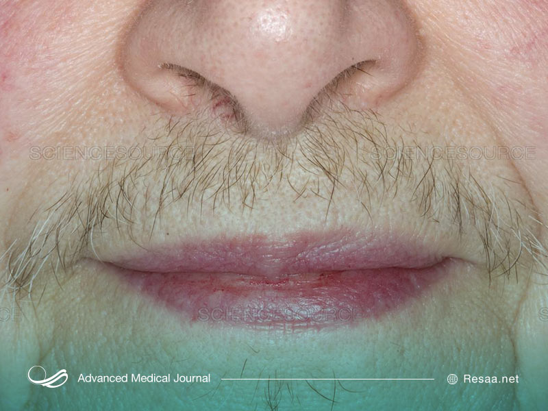 تشخیص پرمویی