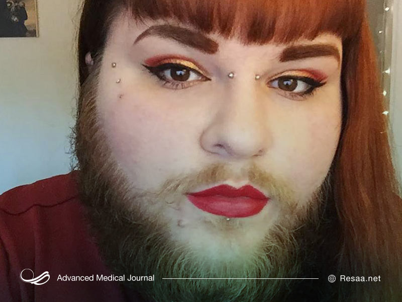 جراحی برای رهایی از موهای زاید