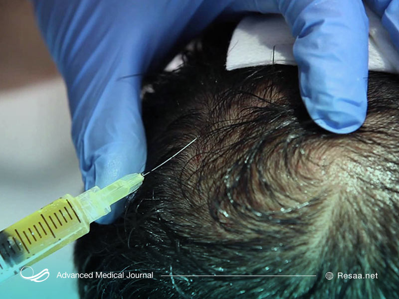 آمادگی برای مزوتراپی