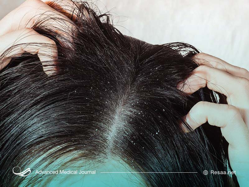 چه چیزهایی باعث چربی پوست سر میشوند