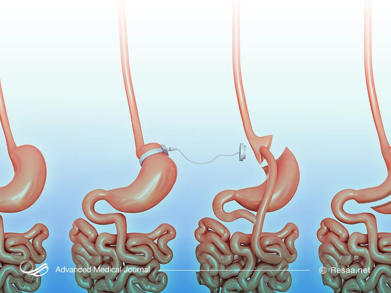 جراحی معده و کاهش اشتها