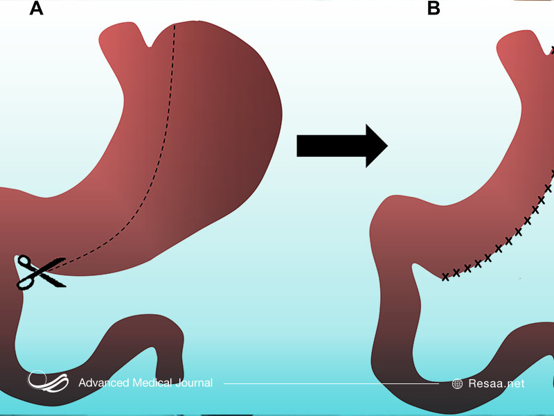 عمل اسلیو معده چیست؟