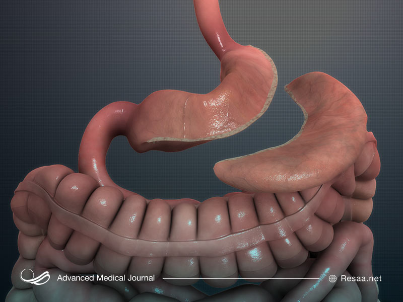 کاهش حجم معده با عمل اسلیو