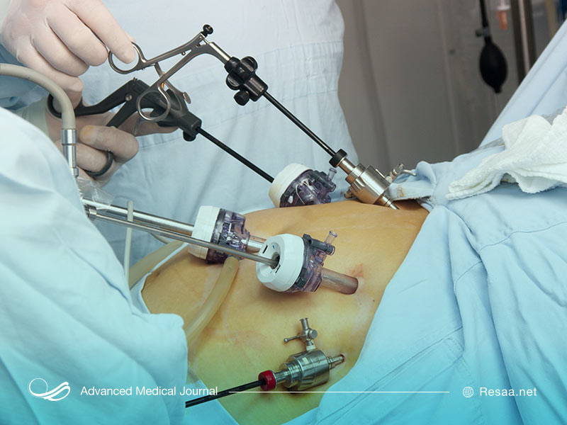تصویری از عمل جراحی اسلیو