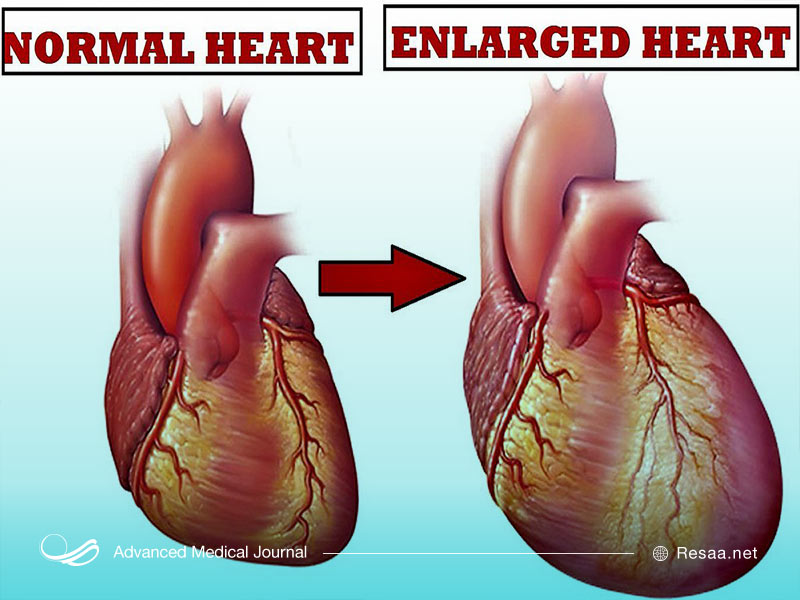 از بزرگ شدن قلب چه میدانید