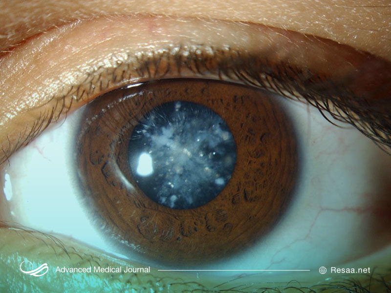 بیماری آب موارید چگونه ایجاد میشود