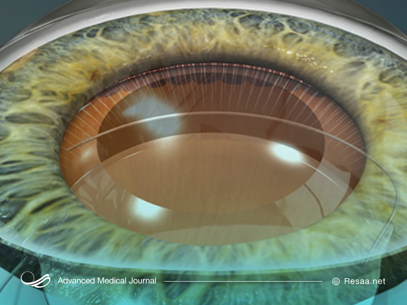 چه چیزهایی اب مروارید را تشدید میکنند