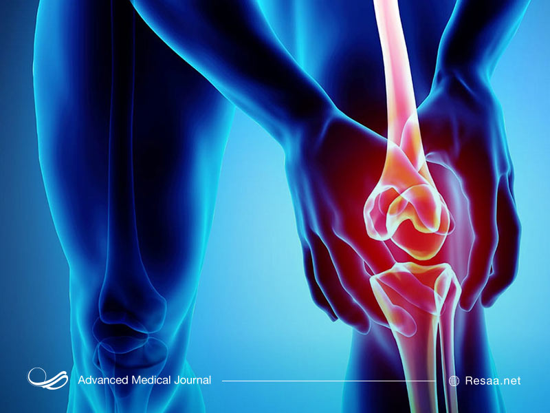 آرتروز زانو یا استئو آرتریت