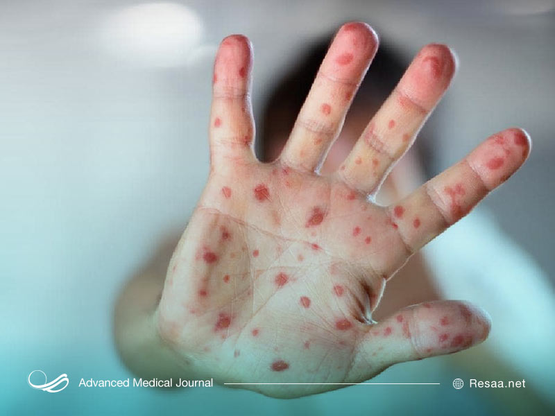 تفاوت سرخجه و سرخک