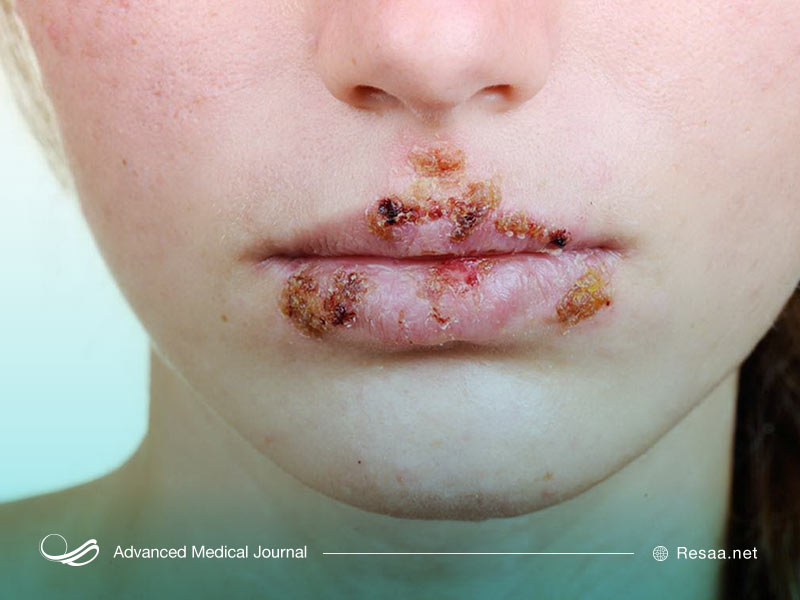 بیماری کلامیدیا چیست