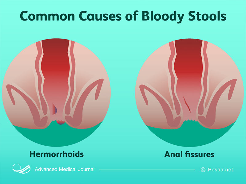 مشاهده خون در مدفوع