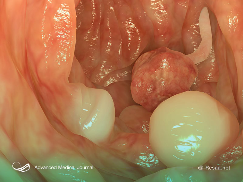 مراجعه به پزشک و درمان خون در مدفوع
