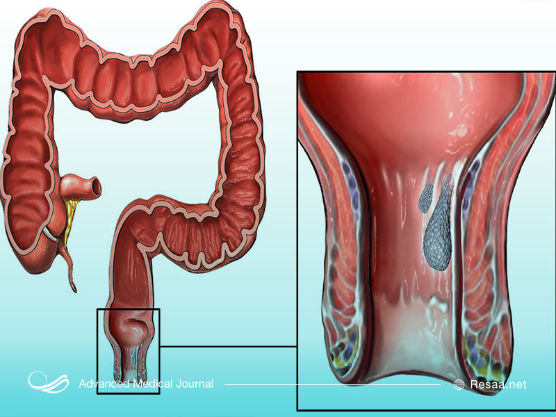 بواسیر میتواند باعث خونریزی هنگام دفع شود