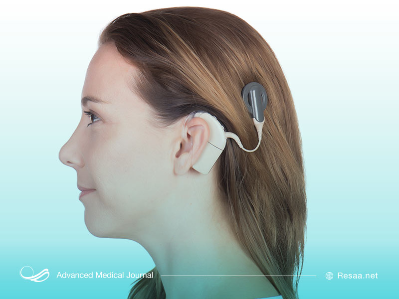 ایمپلنت حلزونی گوش چیست؟