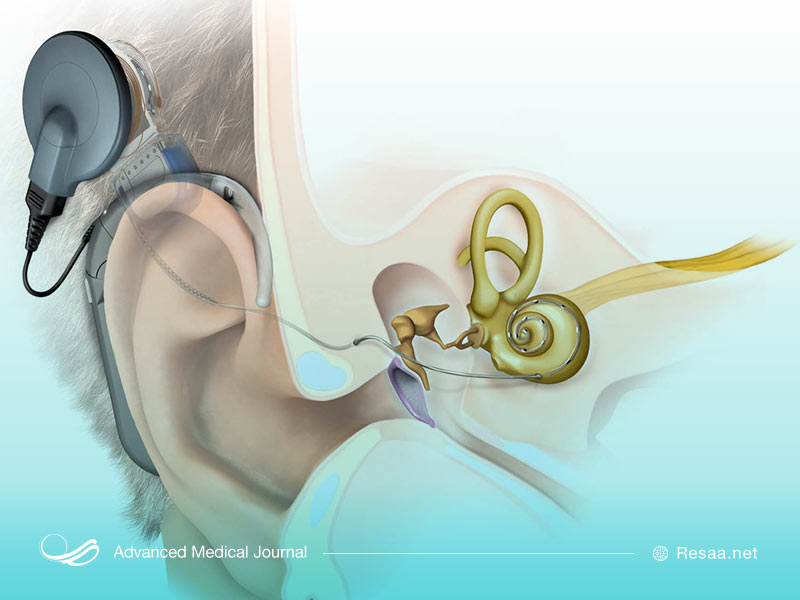 نحوه عمل ایمپلنت حلزونی