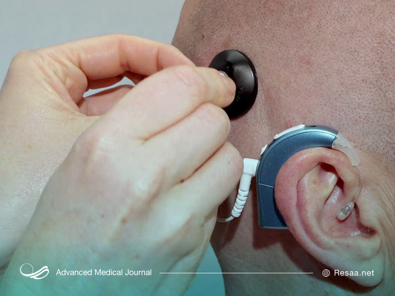 سمعک یا ایمپلنت حلزونی؟