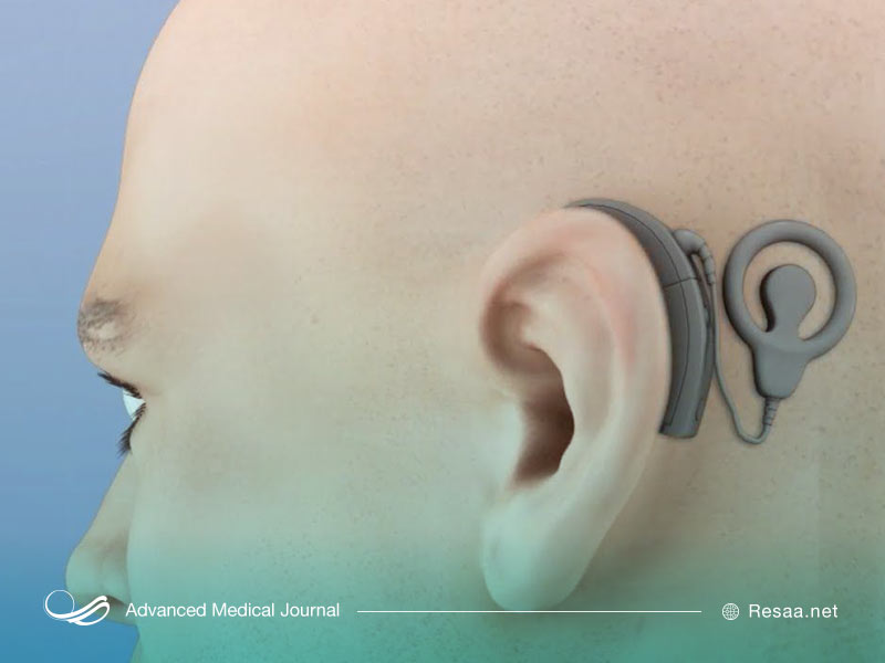 شرایط استفاده از ایمپلنت گوش