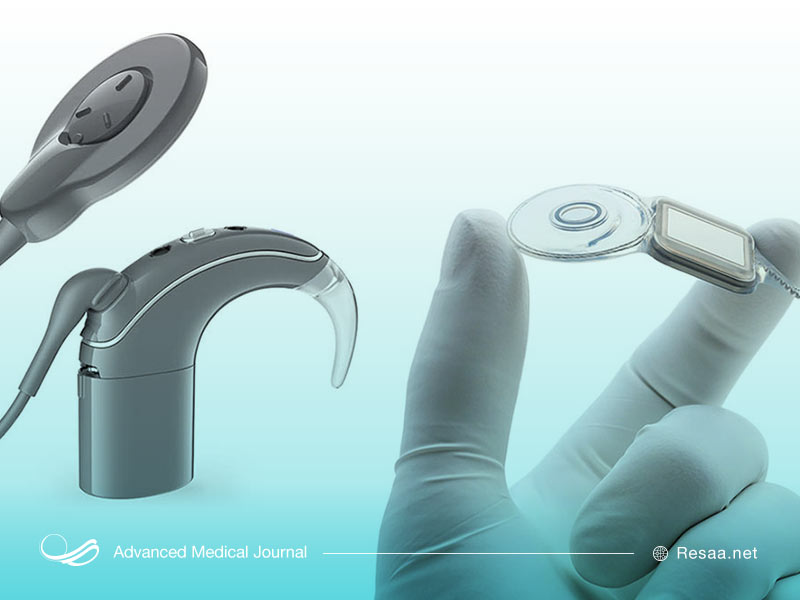 کاشت حلزونی گوش