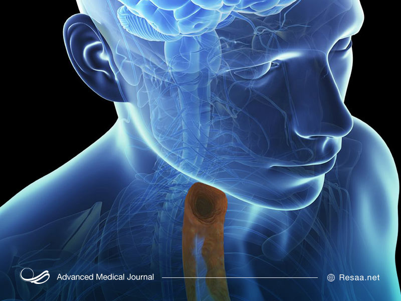 عوامل تشدید کننده التهاب مری