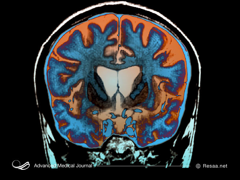 ریشه بیماری هانتینگتون