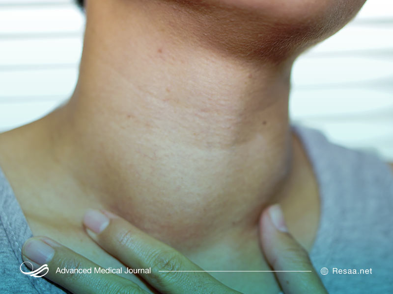 پرکاری تیروئید چیست؟