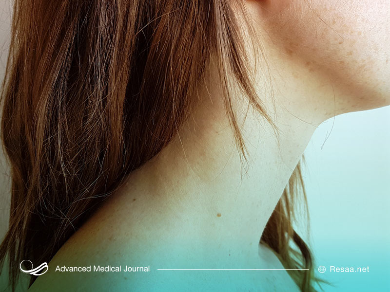 عدم تعادل هورمونی