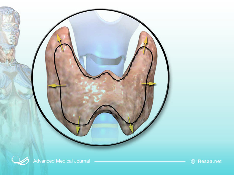 تنگی نفس از نشانه های پرکاری تیروئید است