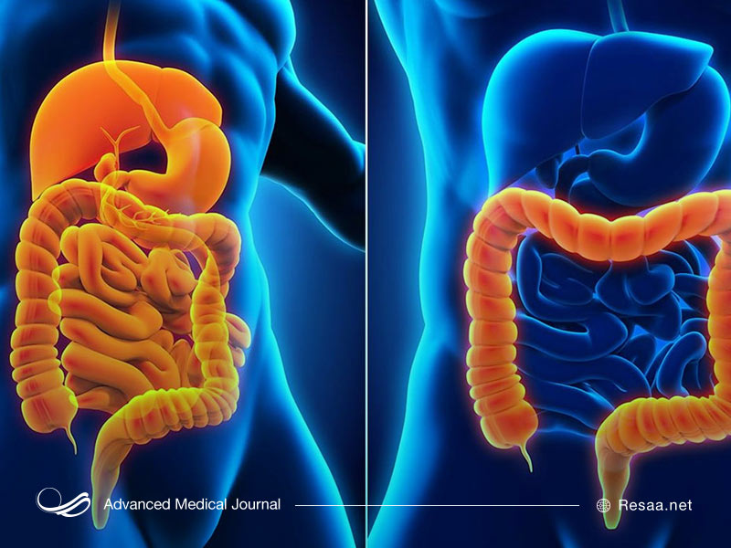 بیماری کولیت روده انواع مختلفی دارد