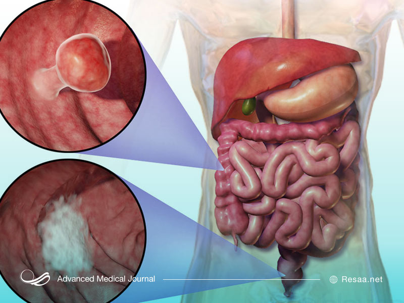 روشهای تشخیص بیماری کولیت