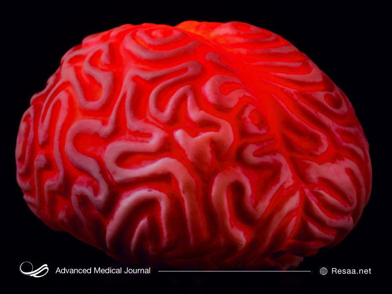 خونریزی مغزی یا خونریزی درون جمجمه ای