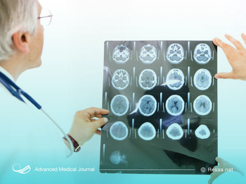 انواع خونریزی مغزی