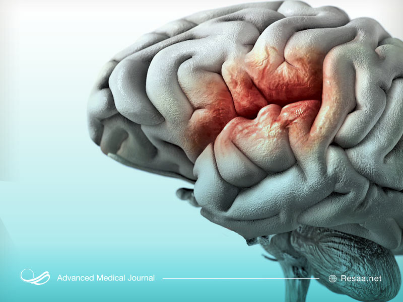 علایم خونریزی مغزی