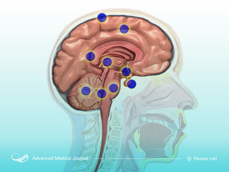 روشهای درمان خونریزی مغزی
