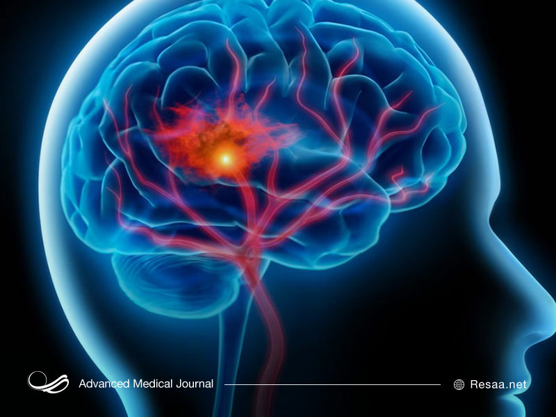 جلوگیری از خونریزی مغزی با رعایت نکات ساده