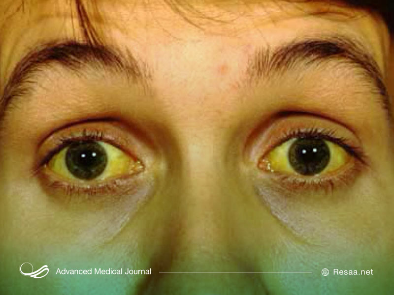 دلایل ایجاد زردی در بدن