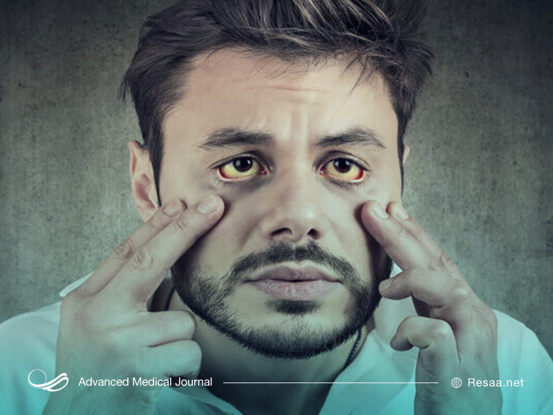 سوءمصرف مواد مخدر در به وجود امدن یرقان موثر است
