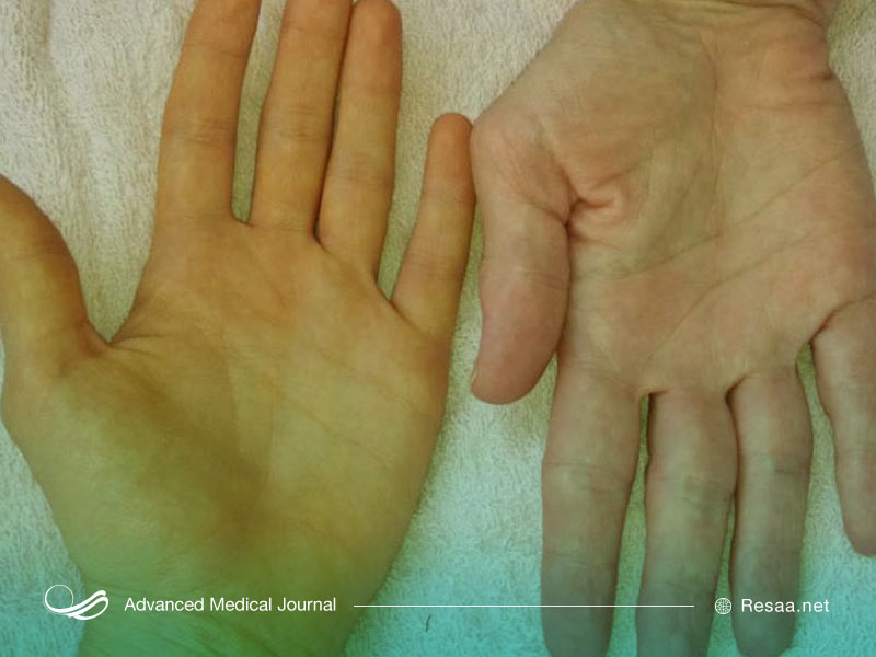 روشهای تشخیص بیماری زردی