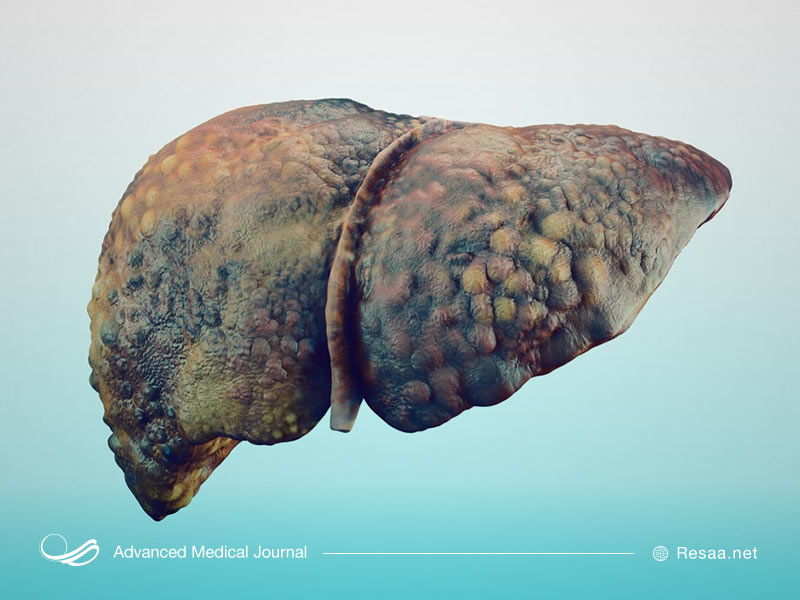 علایم بیماری سرطان کبد
