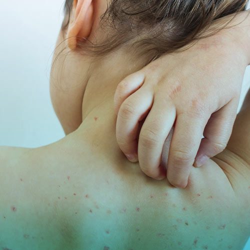 بیماری سرخک چیست؟