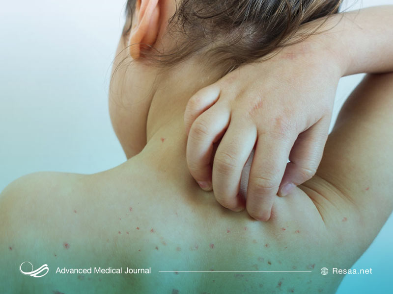 بیماری سرخک تقریبا همه افراد را تا سن 20سالگی یکبار درگیر خود میکند