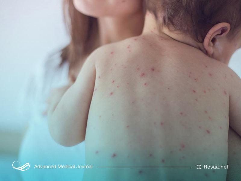 روند ایجاد بیماری سرخک