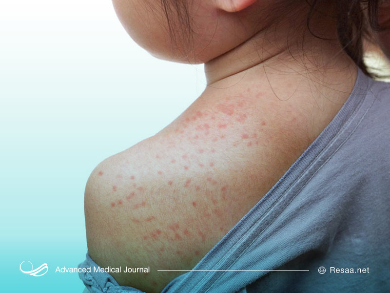 از بیماری سرخک چه میدانیم