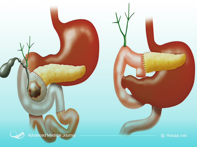 کاهش درد پانکراتیت