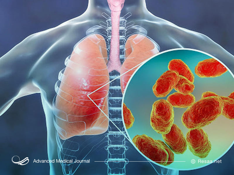 انواع پنومونی