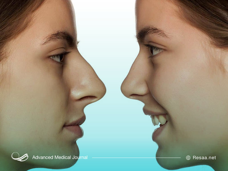 برداشتن قوز بینی