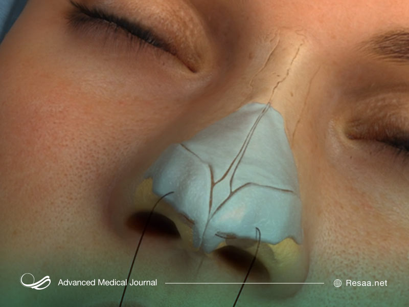 مشکلات عفونی پس از عمل بینی