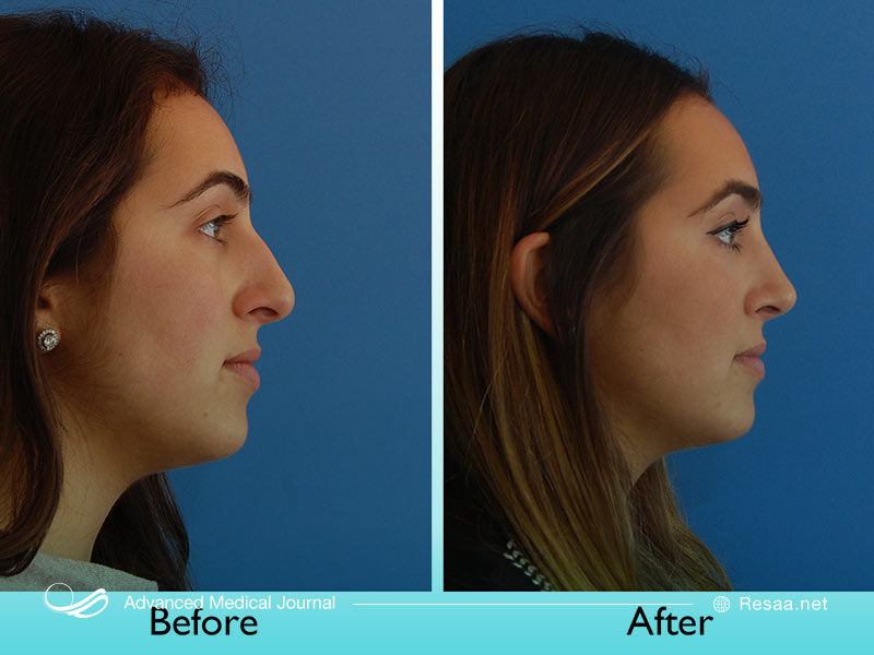 تغییرات ظاهری در اثر عمل بینی