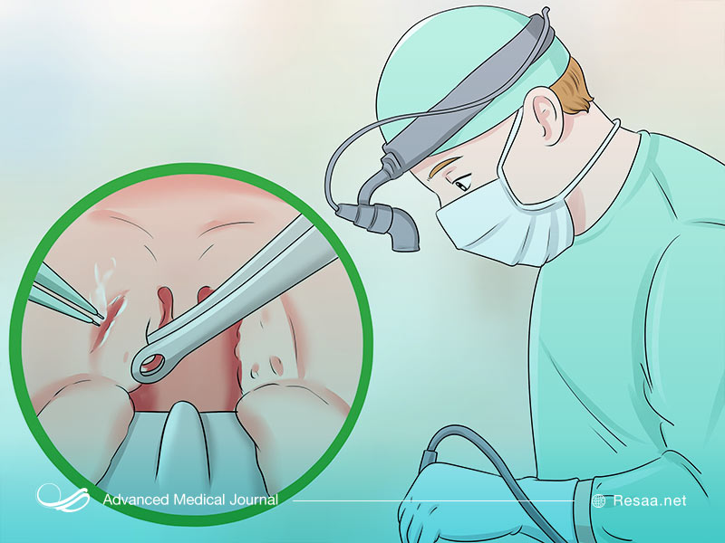جراحی برای درمان خروپف