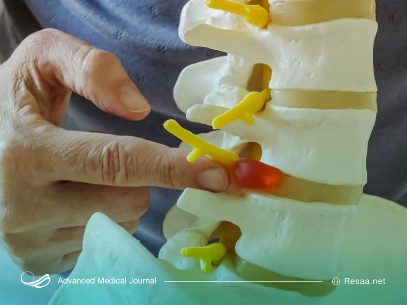 بیماری دژنراسیون دیسک